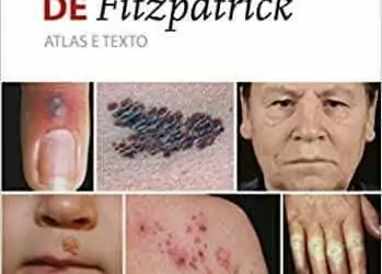 Dermatologia de Fitzpatrick (Wolff) - 7. ed. PDF