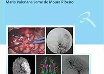 Doença Cerebrovascular na Infância e Adolescência (Ribeiro) - 1. ed. PDF