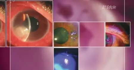 Antibioterapia na Superfície Ocular: guia prático – 2. ed. PDF